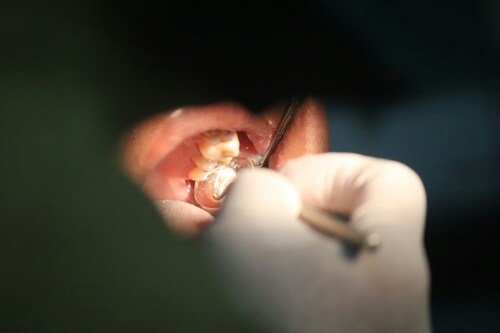 How a Dentist in Kitchener Helps Prevent Cavities